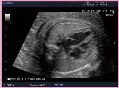 図1　‌30週，胎児の4CV画像