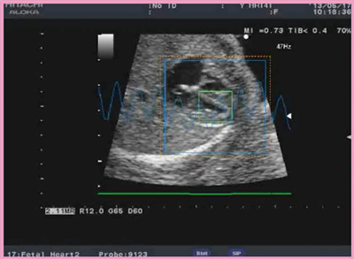 図2　2D Speckle-Tracking法による妊娠初期の胎児心拍数の検出