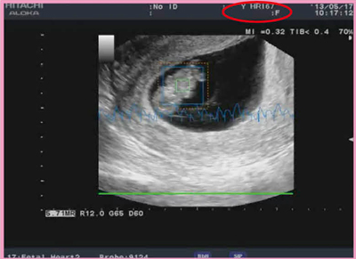 図3　妊娠十数週程度の胎児の心拍数を検出