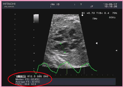 図4　2D Speckle-Tracking法による胎児の心室収縮能の評価