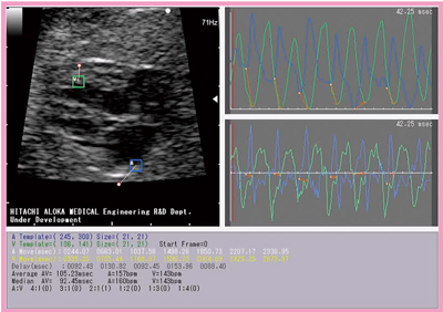 図5　2D Speckle-Tracking法による胎児不整脈の評価