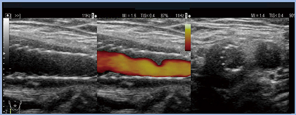 図2　症例3：頸動脈エコーによるCAS後のplaque protrusionの評価