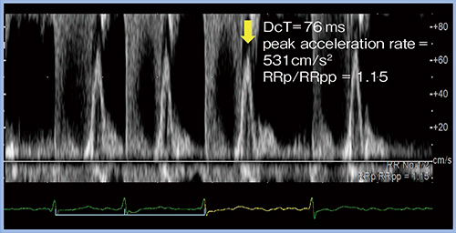 図4　‌R-R Navigationを用いた心房細動症例のDcTの評価