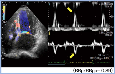 図5　Dual Gate DopplerとR-R Navigationによる心房細動症例のE/e’の測定