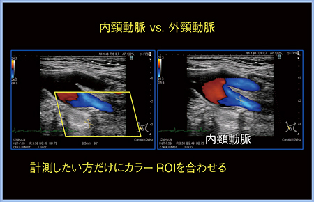 図4　iVascularによる内頸動脈と外頸動脈の同時描出