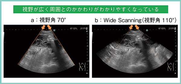 図4　C23RV/C23の2つの視野角の比較（腹腔内膿瘍）