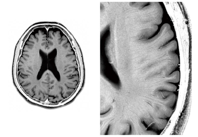 図5　3T MRI画像例：頭部，2DFSE T2WI