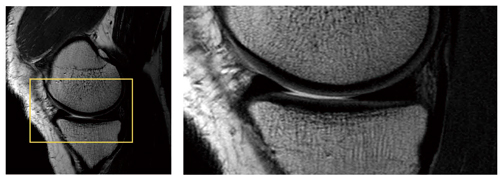 図6　3T MRI画像例：膝関節，FSE PDWI（1024マトリックス）