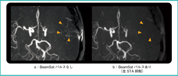 図8　臨床画像3：左STA-MCAバイパス手術後