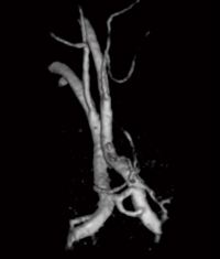 図3　前大脳動脈の高精細MRA（VR）