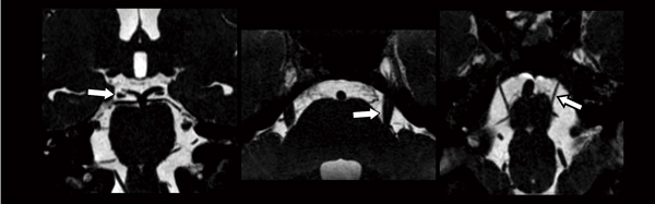 図6　3D-BASGによる神経・血管の描出