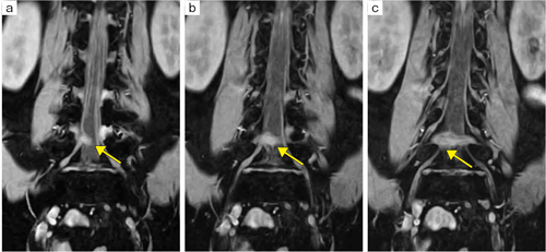 症例2：神経根MRI画像（Level2のMRI検査）