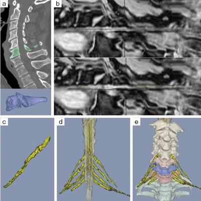 症例4：3D MRI/CT Fusion Imaging（Level3のMRI検査）