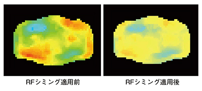 図6　RFシミングによる照射分布の均一度向上効果