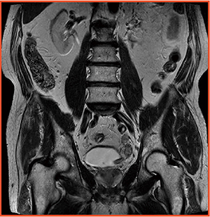 図1　4ch RF シム技術：尿管癌の2D FSE RG（FOV38cm，5mm，3min）