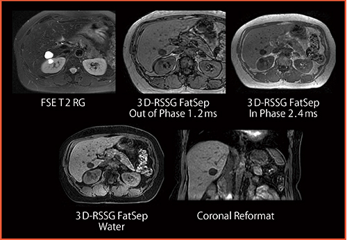 図2　2 Point Dixon法（2mmスライス，息止め19s）