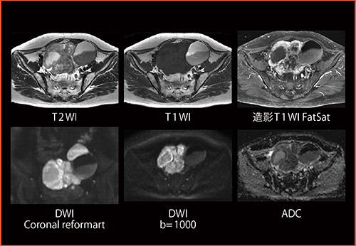 図3　Female Pelvis：卵巣腫瘍