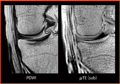 図5　Knee PDWI：μTEサブトラクション法