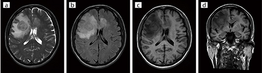 臨床例1：脳腫瘍（Soft Sound ON）