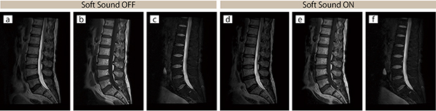 腰椎撮像におけるSoft Sound OFF（a 〜c）/ON（d 〜f）の比較。スライス厚はすべて4 mm。撮像時間はほぼ同等となっている。 a： T 2 WI，SAG，2：46 b： T 1 WI，SAG，2：42 c： T 2 WI，Fatsat，SAG，2：43 d：T 2 WI，SAG，2：51 e： T 1 WI，SAG，2：46 f ： T 2 WI，Fatsat，SAG，2：52
