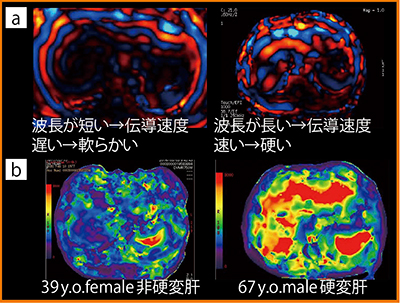 図1　MR elastography