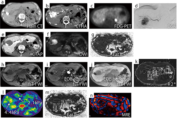 図2　悪性リンパ腫（70歳代，男性）