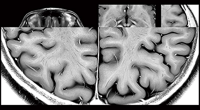 図1　32chヘッドコイルを用いた高解像度画像