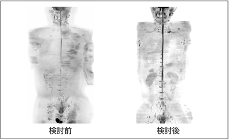 図2　条件検討前後のBody DWI画像比較