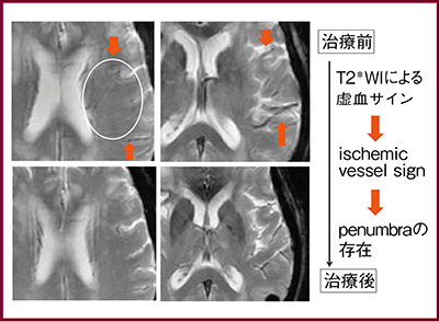 図3　治療前後のMR画像：T2＊強調画像