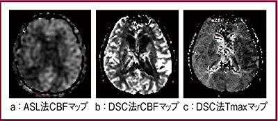 図4　脳虚血におけるASL法とDSC法の比較 pCASL画像とDSC各種パラメータマップ
