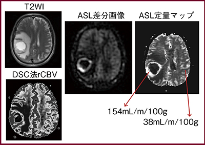 図5　脳腫瘍におけるASL法とDSC法の比較