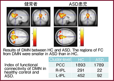図6　自閉症（ASD）におけるrsfMRI自験例