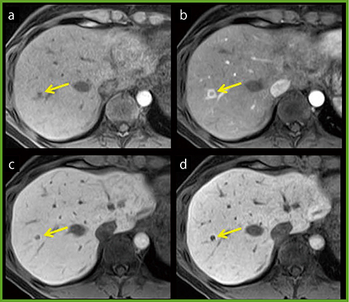 図4　転移性肝腫瘍症例のEOB造影MRI a：pre　b：arterial phase　c：hepatobiliary phase d：hepatobiliary phase（thin slice）