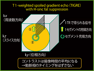 図5　TIGREのk空間充填方法