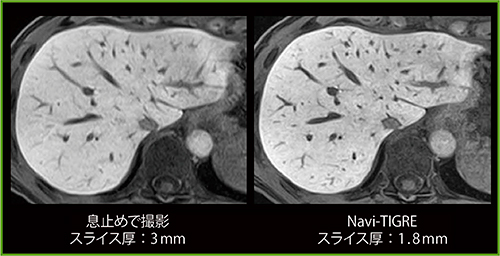 図7　Navi-TIGRE使用の有無によるEOB造影MRI肝細胞造影相の比較