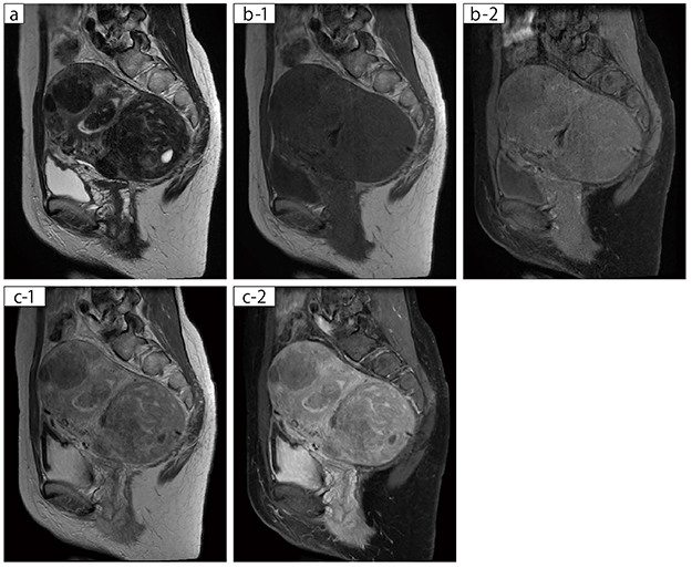 50歳代，女性。後壁側に長径85mmほどの筋層内筋腫の存在が明瞭。腹側はじめ長径30～50mm程度の筋層内筋腫の多発。子宮内腔の過伸展と頂部付近に長径35mmの内膜下筋腫も指摘できる。 a：T2WI，FOV：250mm，TR/TE＝5577/100 b-1：FatSep T1WI-元画像（Multi Contrast） b-2：FatSep T1WI-脂肪抑制画像（Multi Contrast） 　　　FOV：250mm，TR/TE＝690/13 c-1：CE-FatSep T1WI-元画像（Multi Contrast） c-2：CE-FatSep T1WI-脂肪抑制画像（Multi Contrast）  　　　FOV：250mm，TR/TE＝690/13