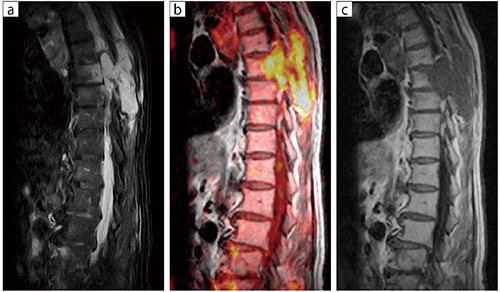 80歳代，男性。肺と前立腺に原発性の腫瘍があり，胸部背部痛を訴えるため精査。DWIにて高信号を認めたため，転移性骨腫瘍と診断。低磁場MRIでも骨転移のDWI撮像が可能。 a：T2WI FatSep，TR/TE＝3600/72，スライス厚：5mm，FOV：330mm b：DWI（T1 Fusion），TR/TE＝4500/120，スライス厚：5mm，FOV：330mm c：T1WI，TR/TE＝350/14.8，スライス厚：5mm，FOV：330mm
