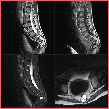 図4　症例2：Regional RF Shimmingを適用した小児の二分脊椎症の画像