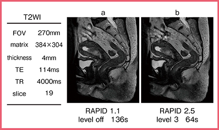 図6　症例3：子宮体がんのT2強調画像へのINRの適用