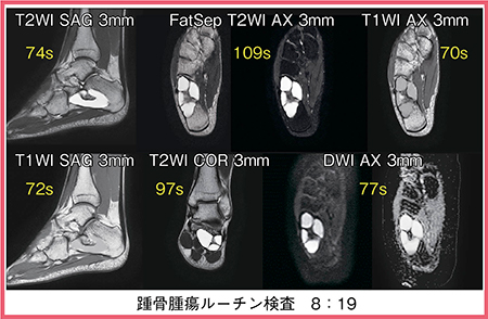 図8　症例5：踵骨腫瘍ルーチン検査におけるINRの効果