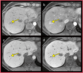 図2　図1の症例のEOB造影MRI a：pre　b：arterial phase c：hepatobiliary phase d：hepatobiliary phase（thin slice）