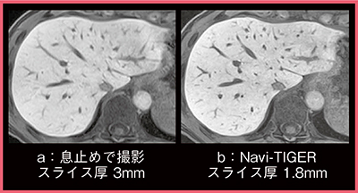 図3　Navi-TIGRE使用の有無によるEOB造影MRI肝細胞造影相の比較