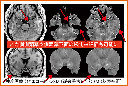 図3　脳表補正のQSM解析（W.I.P.）