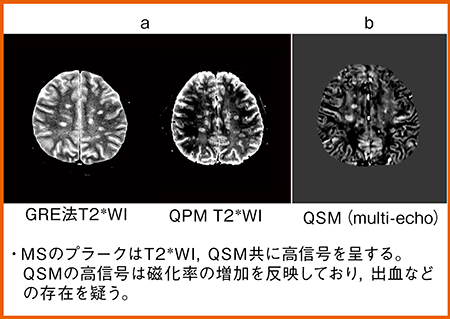 図3　症例1：QPMによる磁化率画像