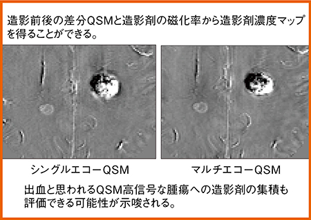 図4　QSMによる造影剤濃度マップ（脳転移症例）
