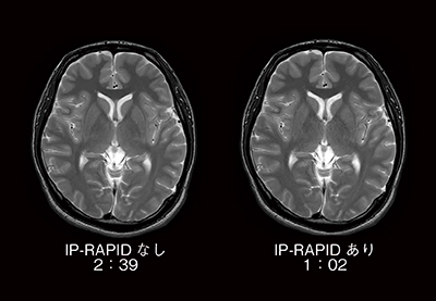 図3　T2強調画像におけるIP-RAPID有無の比較 撮像時間が半分以下においても，同等の画質が得られている。