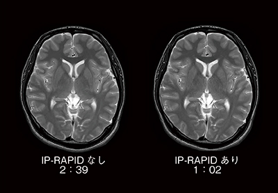 図3　T2強調画像におけるIP-RAPID有無の比較 撮像時間が半分以下においても，同等の画質が得られている。