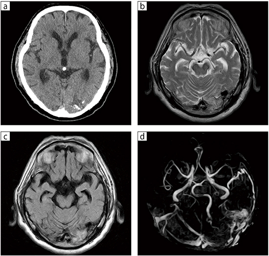 75歳，男性。車の運転中に視野障害を認め受診。頭部CTで左後頭葉に多数の点状の石灰化と，その周辺に脳浮腫と思われる低吸収域を認めた（a）。MRIのT2WI，FLAIRでは浮腫と思われる高信号域を認め，多数の拡張した血管によるflow voidを認める（b，c）。MRAでは，拡張した硬膜枝と後頭動脈から静脈洞・脳表静脈への異常血流を認める（d）。 a：CT b：T2WI，TR/TE＝5000/100，スライス厚：6mm，FOV：220mm，FA：90° c：FLAIR，TR/TE/TI＝8000/90/1800，スライス厚：6mm，FOV：220mm，FA：90° d：MRA MIP，TR/TE＝33/6.5，スライス厚：1.3mm，FOV：180mm，FA：30°