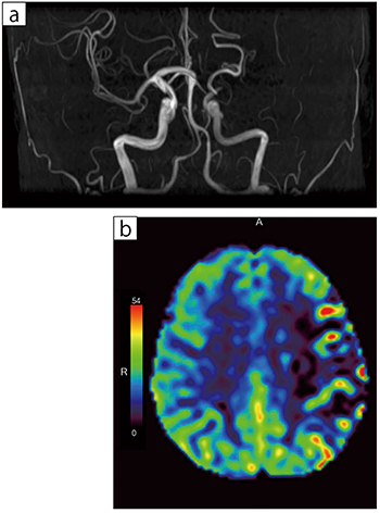 50歳代，女性。MRAで左中大脳動脈の閉塞を認め，ASL Perfusionを実施。ASL Perfusionでは同領域に低灌流域として描出された。後日，SPECT検査を実施し，健側に比して10％のCBF低下が確認された。 a：3D TOF MRA，TR/TE＝20.8/6.9，FA：20°，スライス厚：1.2mm b：3D ASL Perfusion，TR/TE＝4250/19.6，FA：90°，スライス厚：6.0mm，PLD：1500ms