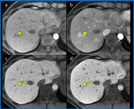 図2　EOB造影MRI　転移性肝腫瘍